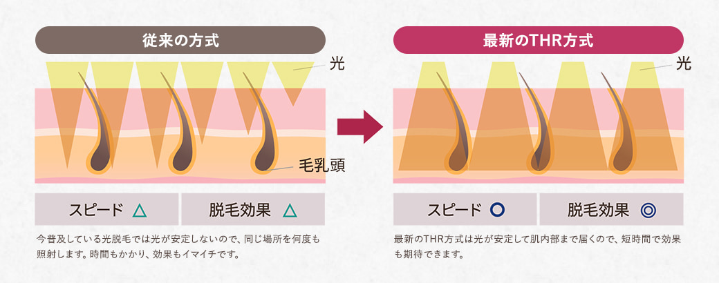 従来の方式：今普及している光脱毛では光が安定しないので、同じ場所を何度も照射します。時間もかかり、効果もイマイチです。 最新のTHR方式：最新のTHR方式は光が安定して肌内部まで届くので、短時間で効果も期待できます。